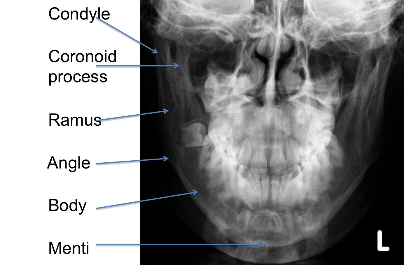 Coronoid Process Radiograph